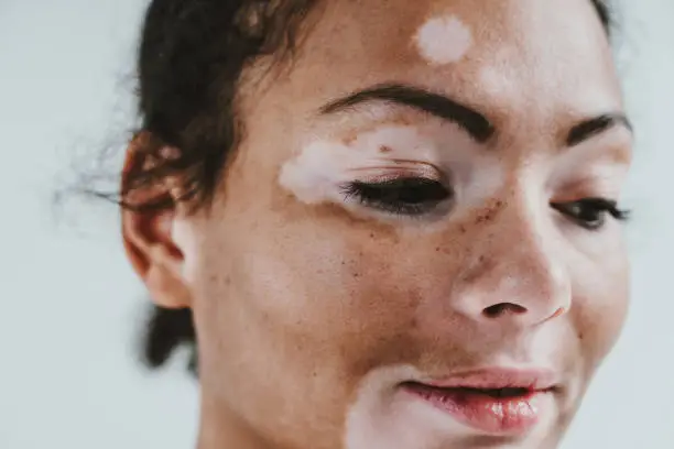 Photo of Beautiful woman with vitiligo skin posing in studio. Concept about body positivity and self acceptance