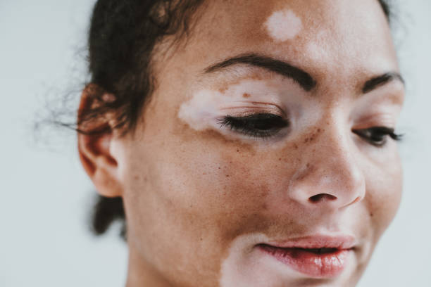 beautiful woman with vitiligo skin posing in studio. concept about body positivity and self acceptance - body positive imagens e fotografias de stock