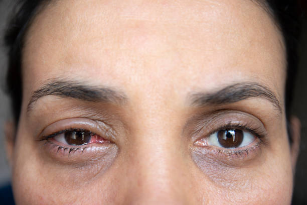 istock young woman after eye surgery. 1310892643