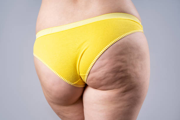 Overweight woman with fat hips and buttocks, obesity female body with cellulite on gray background Overweight woman with fat hips and buttocks, obesity female body with cellulite on gray background, studio shot cellulite stock pictures, royalty-free photos & images
