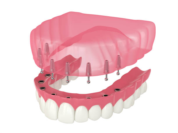 istock 3d render of removable snap-on full implant denture installation 1311049227