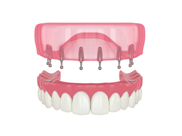 istock 3d render of removable snap-on full implant denture installation 1311049229