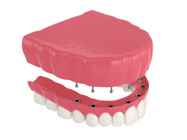 istock 3d render of removable snap-on full implant denture installation 1311049232