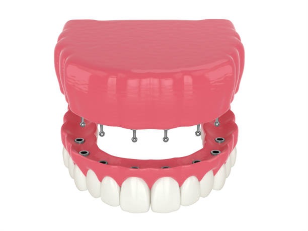 istock 3d render of removable snap-on full implant denture installation 1311049235