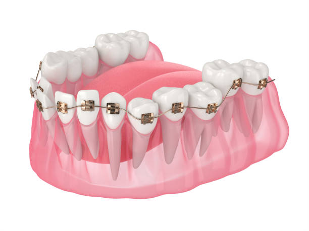 istock 3d render of teeth alignment by orthodontic braces 1311049242
