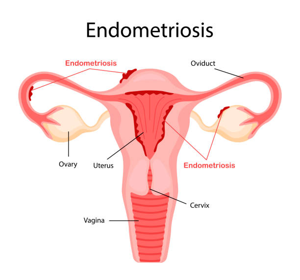 bildbanksillustrationer, clip art samt tecknat material och ikoner med diagram över endometrios. sjukdomar i det kvinnliga reproduktionssystemet. vektor illustration i en platt tecknad stil. - äggledare illustrationer