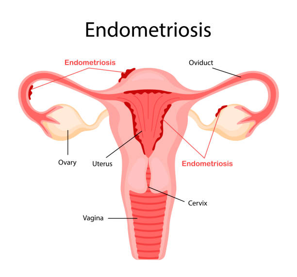 Diagram of endometriosis. Diseases of the female reproductive system. Vector illustration in a flat cartoon style. Diagram of endometriosis. Diseases of the female reproductive system. Vector illustration in a flat cartoon style. endometriosis stock illustrations