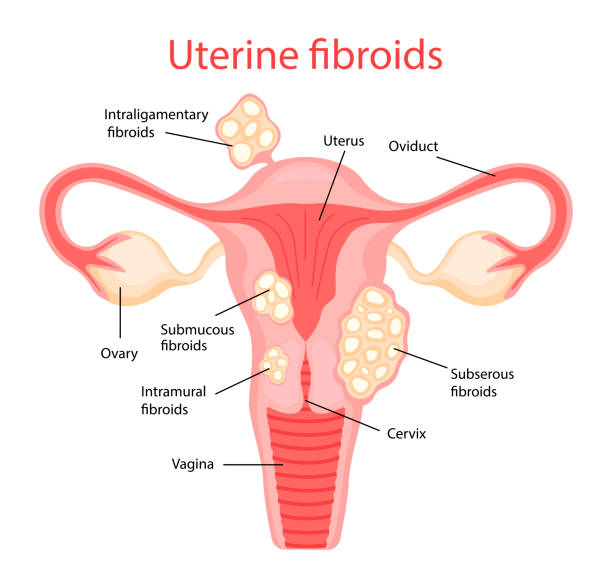 istock Fibroids. Diseases of the female reproductive system. Vector illustration in flat cartoon style 1311056428
