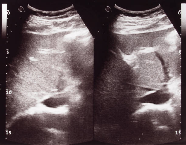 istock Diagnostic sonography of abdomen 1311070934
