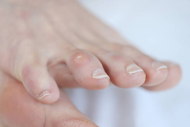 primer plano del callo seco en el dedo del pie de la mujer - podiatrist pedicure human foot healthy lifestyle fotografías e imágenes de stock