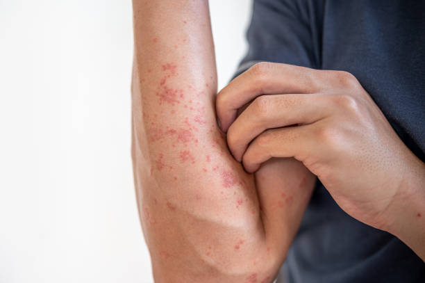 istock Dermatitis, Eczema skin from air pollution and stress 1311098436