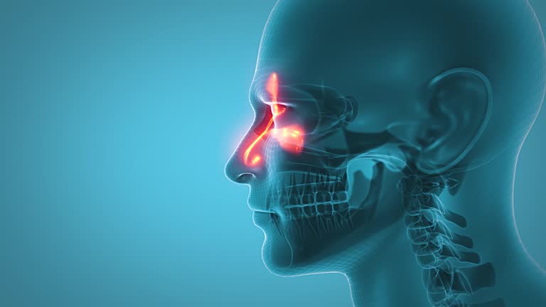 Sinusitis