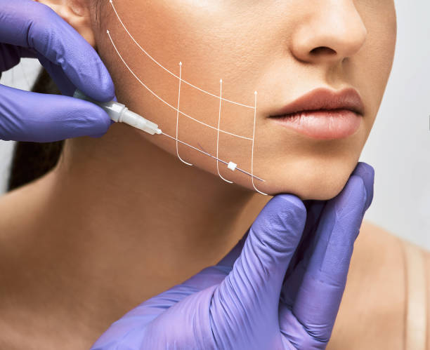 gezichtsheffen draad. draad facelift met pijlen op gezicht voor de huid van de vrouw, procedure gezichtscontouren met behulp van mesothreads - oppakken stockfoto's en -beelden