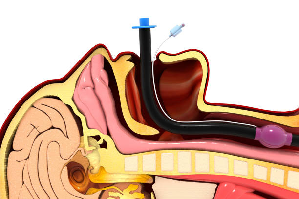 istock Endotracheal intubation on white background. 3d illustration 1311254212