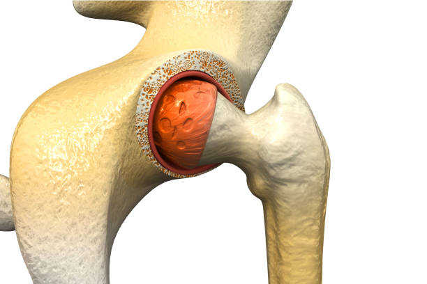 istock Human hip joint. arthritis of the hip joint. 3d illustration 1311255438