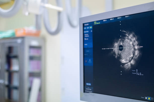 istock Intravascular ultrasound imaging (IVUS) at cardiac catheterization laboratory room. 1311267590