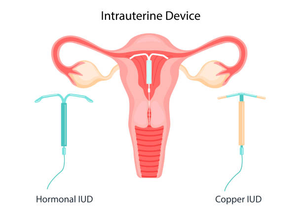 The method of IUD-contraception. Control and protection of pregnancy. Intrauterine device in the uterus. vector illustration in a flat style. The method of IUD-contraception. Control and protection of pregnancy. Intrauterine device in the uterus. vector illustration in a flat style. iud stock illustrations