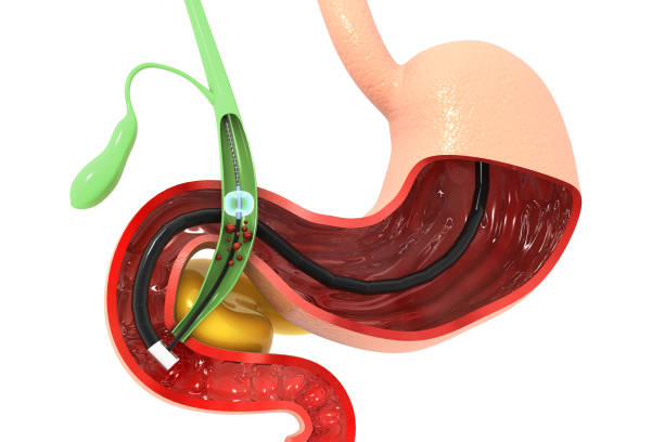 istock Gallstones removing the gallbladder. 3d illustration 1311642580