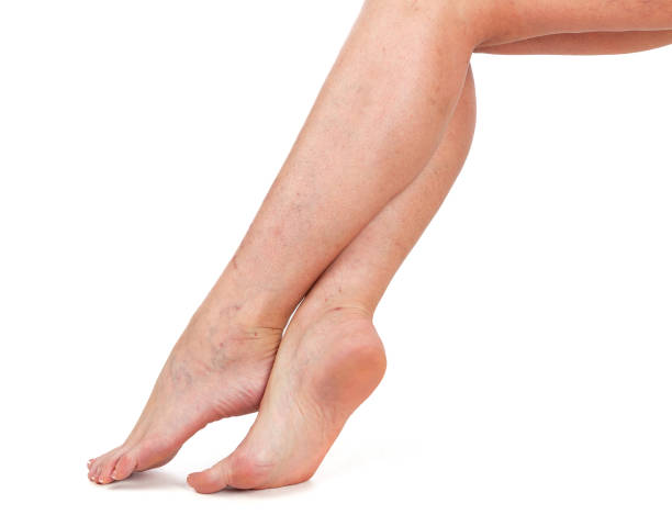 Beine einer Frau. Haut mit Gefäßsternen. Weißer Hintergrund – Foto