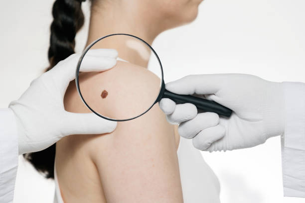 The doctor's gloved hands point through a magnifying glass at the birthmark on the woman's shoulder. The concept of moles and skin cancer The doctor's gloved hands point through a magnifying glass at the birthmark on the woman's shoulder. The concept of moles and skin cancer. mole stock pictures, royalty-free photos & images