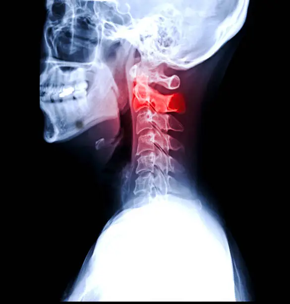 Photo of X-ray C-spine or x-ray image of Cervical spine lateral view for diagnostic intervertebral disc herniation and Spondylosis.