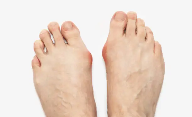 Varus valgus and Hallux valgus, bunion on white background. With clipping path