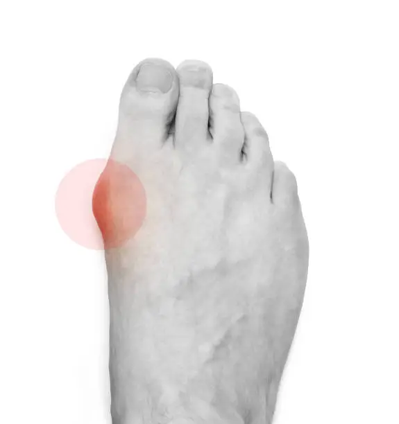 Varus valgus and Hallux valgus, bunion on white background. With clipping path