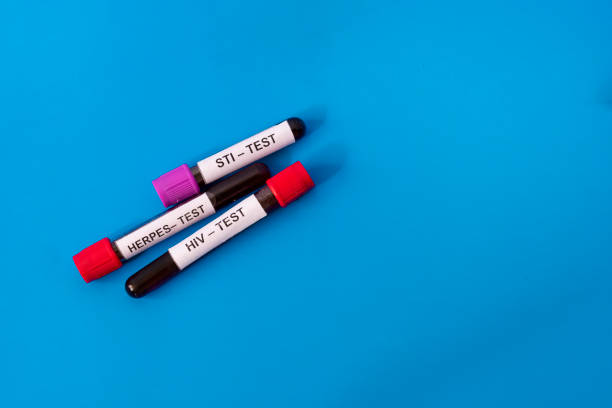 파란 배경에 고립 된 성병 검사를위한 혈액 튜브 3 개. hiv, 헤르페스, sti에 대한 테스트. 에이즈 예방 개념 - sti 뉴스 사진 이미지