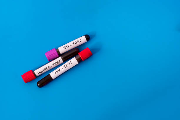 three tubes of blood for testing for sexually transmitted diseases isolated on a blue background. testing for hiv, herpes, sti. aids prevention concept - sti imagens e fotografias de stock