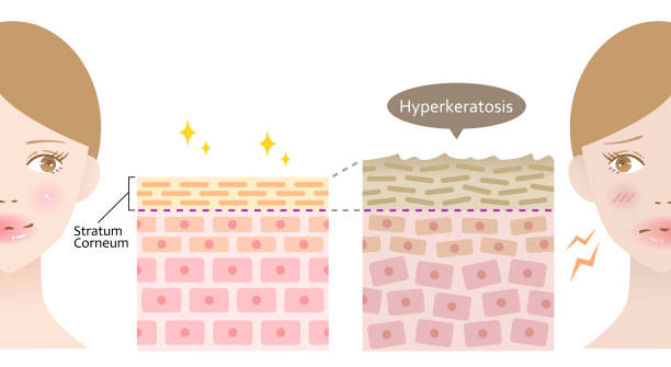 illustrations, cliparts, dessins animés et icônes de diagramme de l’épaississement de la cornée de strate et du visage de femme. traitement de beauté avant après illustration. concept de soin de peau et de beauté - human skin dry human face peeling