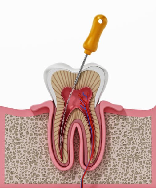 ilustración 3d del tratamiento del conducto radicular - dental drill fotografías e imágenes de stock
