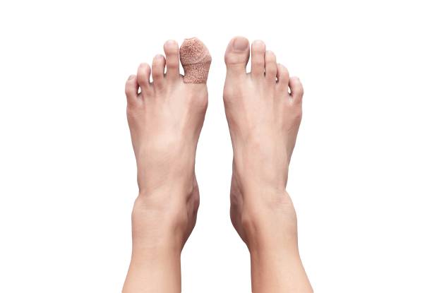 imagen de dos pies femeninos humanos desnudos con un dedo gordo del pie herido curado con vendaje para recibir atención médica. aislado en blanco - 4453 fotografías e imágenes de stock