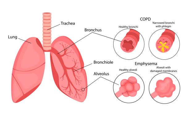 COPD (chronic obstructive pulmonary disease). Emphysema of the lungs. Lung disease. Infographics. Vector illustration in cartoon style isolated on white background. COPD (chronic obstructive pulmonary disease). Emphysema of the lungs. Lung disease. Infographics. Vector illustration in cartoon style isolated on white background. alveolus stock illustrations