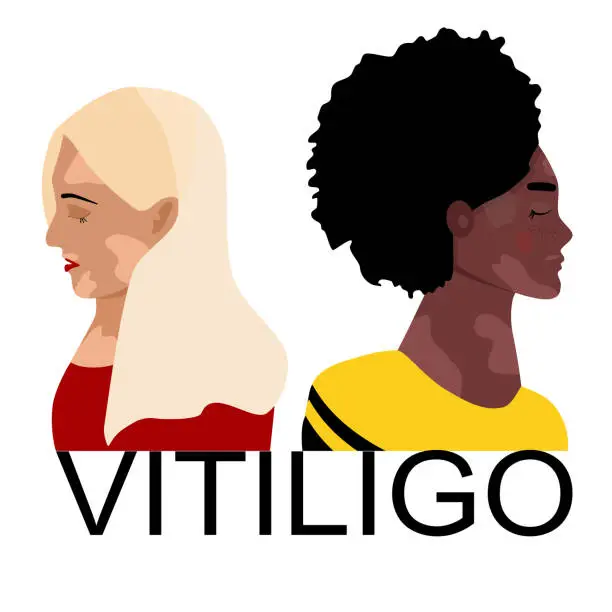 Vector illustration of World vitiligo day.Young women different ethnicities with skin disease. Depigmentation problem. Patchy loss of derma color.Autoimmune sickness.