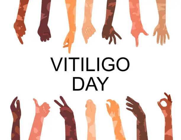 Vector illustration of World vitiligo day poster.Hands different ethnicities in various gestures with skin disease. Depigmentation problem. Patchy loss of derma color. White spots.