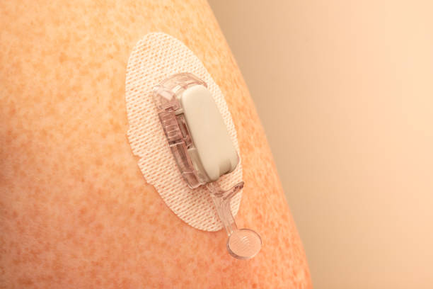 cgm - continuous glucose monitoring: sensor installation on the upper arm. sensor pod. transmitter and transmitter latch - upper arm fotos imagens e fotografias de stock