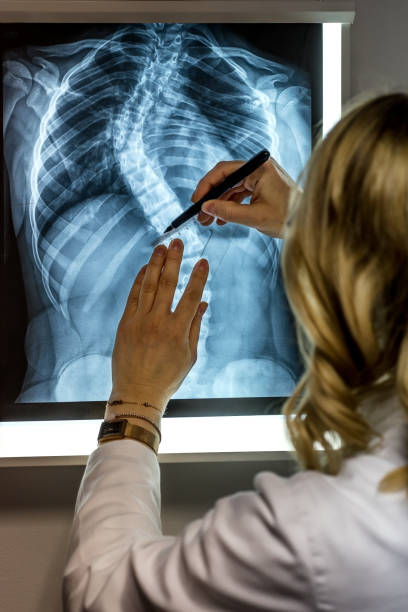 specialista di scoliosi medico con pazienti raggi x - scoliosis foto e immagini stock