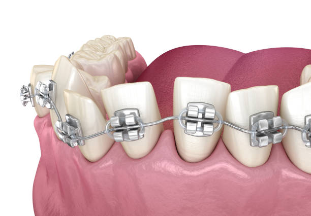 istock Abnormal teeth position and Clear braces tretament. Medically accurate dental 3D illustration 1312577644