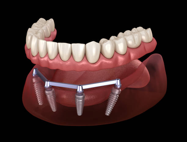 mandibular prosthesis with gum all on 4 system supported by implants.  medically accurate 3d illustration of human teeth and dentures concept - implantat imagens e fotografias de stock