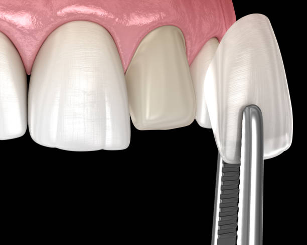 istock Veneer installation procedure over central incisor. Medically accurate tooth 3D illustration 1312577702
