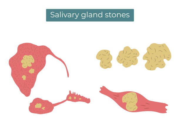 ilustraciones, imágenes clip art, dibujos animados e iconos de stock de ilustración plana vectorial de piedras en las glándulas salivales y conductos parotídicas, submandíbulares y sublinguales. - salivary gland