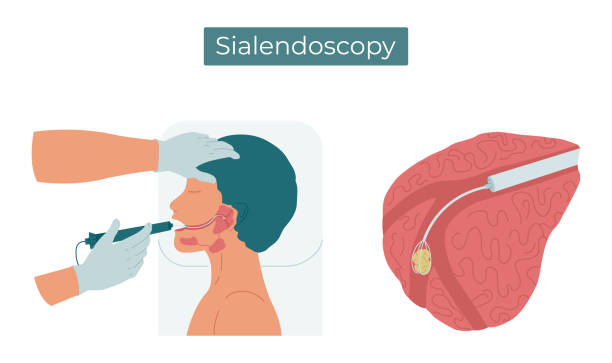 illustrations, cliparts, dessins animés et icônes de illustration plate vectorielle de sialendoscopy. chirurgie pour enlever une pierre du conduit de la glande salivaire parotide. - sublingual