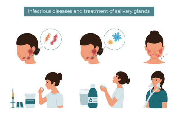 illustrations, cliparts, dessins animés et icônes de illustration plate de vecteur des maladies infectieuses et du traitement salivaire de glande. - sublingual