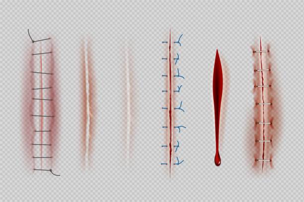 외과 봉합사. 의료 클로즈업 스티치 흉터와 상처 괜찮은 벡터 사실적인 일러스트 - sewing stitches thread surgery stock illustrations