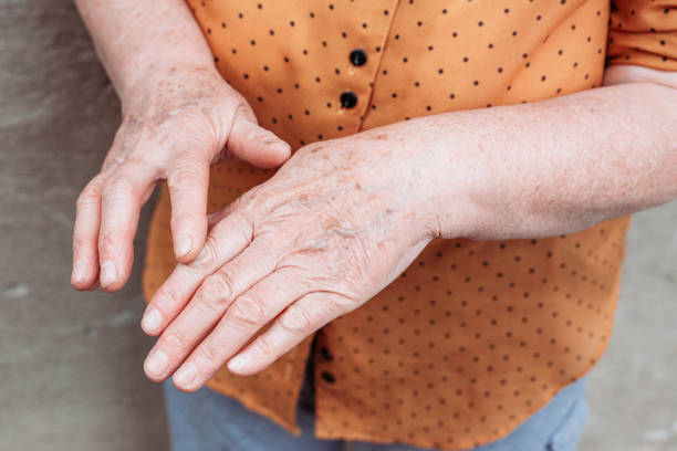 istock Older woman hands. Rheumatism, arthritis, joint pain 1312689389
