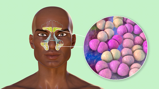 Streptococcus pneumoniae bacteria as a cause of sinusitis. 3D illustration showing purulent inflammation of frontal sinuses in an African man and close-up view of streptococci bacteria