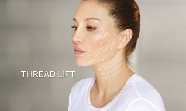 istock Thread Lift ,markup, thread-lift procedure for facial rejuvenation. 1312838476