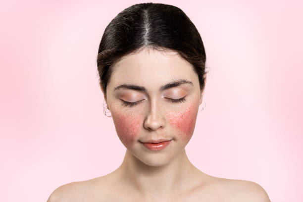 눈을 감고 있는 아름다운 여성의 초상화가 뺨에 염증이 있는 혈관을 보여 주었습니다. 분홍색 배경. 공간을 복사합니다. 로사시아 트리트먼트 컨셉 - capillary 뉴스 사진 이미지