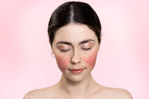 retrato de uma bela mulher com os olhos fechados, mostrando vasos sanguíneos inflamados em suas bochechas. fundo rosa. copie o espaço. conceito de tratamento rosacea - capillary - fotografias e filmes do acervo