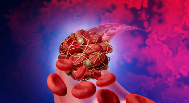 Blood Clot Risk Blood clot health risk or thrombosis medical illustration concept symbol as a group of human blood cells clumped together by sticky platelets and fibrin as a blockage in an artery or vein as a 3D render. blood clot stock pictures, royalty-free photos & images
